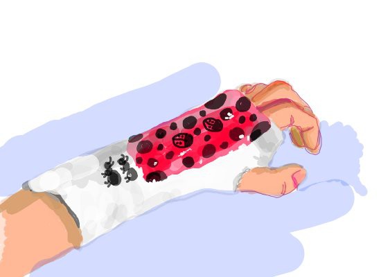 my-broken-hand